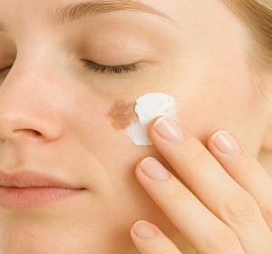 Woman applying glycolic acid cream to pigmentation on face