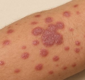 Lichen planus skin lesions on forearm