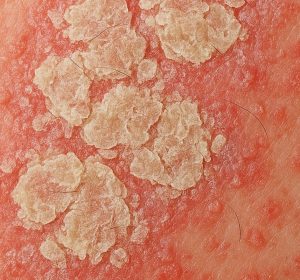 Seborrheic dermatitis closeup on skin