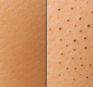 Sebaceous filaments vs blackheads closeup